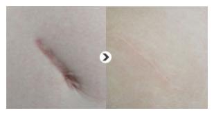 凹陷性疤痕的治療方法是什么?