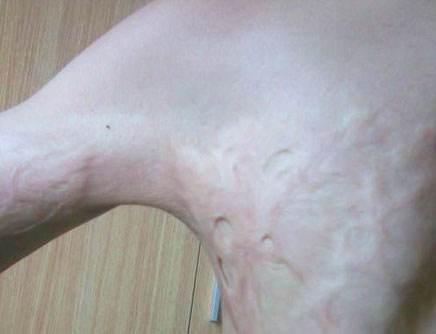 疤痕治療不可忽視的注意事項常識介紹