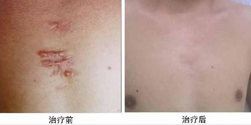 疤痕治療常見的方法有哪些