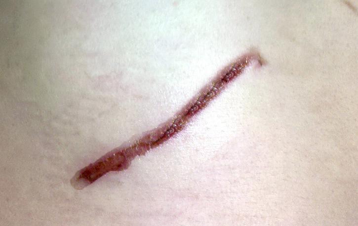 疤痕增生打封閉針效果好不好