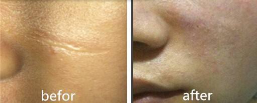 凹陷性的疤痕要怎么治療