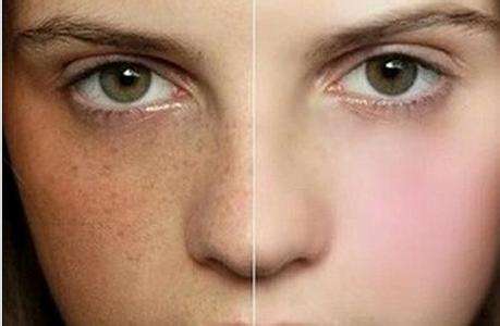 激光<a href=http://m.f3bb6.cn/listinfo-776-0.html target=_blank class=infotextkey>去曬斑</a>前后對比圖