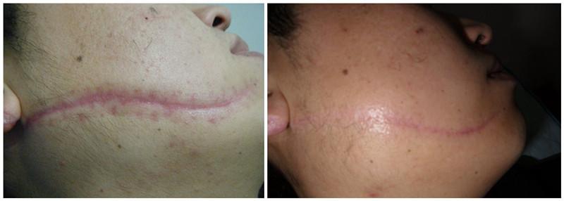 疤痕治療的方法有哪些