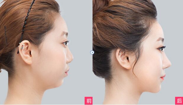 硅膠<a href=http://m.f3bb6.cn/listinfo-737-0.html target=_blank class=infotextkey>隆鼻</a>多久消腫