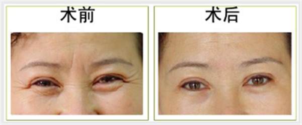 魚尾紋<a href=http://m.f3bb6.cn/listinfo-614-0.html target=_blank class=infotextkey>除皺</a>抗衰安全嗎