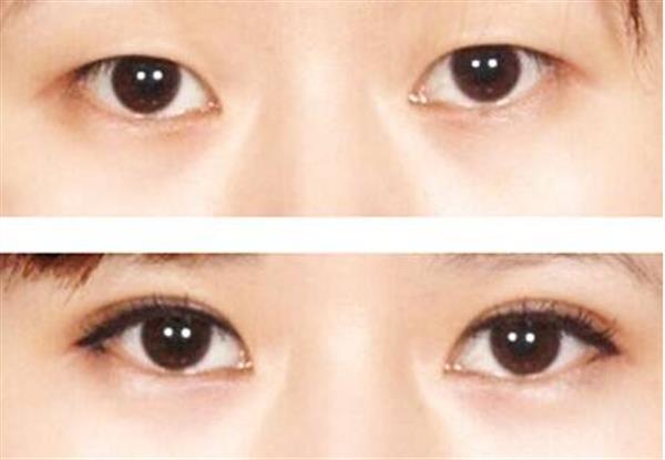 <a href=http://m.f3bb6.cn/listinfo-724-0.html target=_blank class=infotextkey>雙眼皮</a>經(jīng)歷韓式點壓附對比照