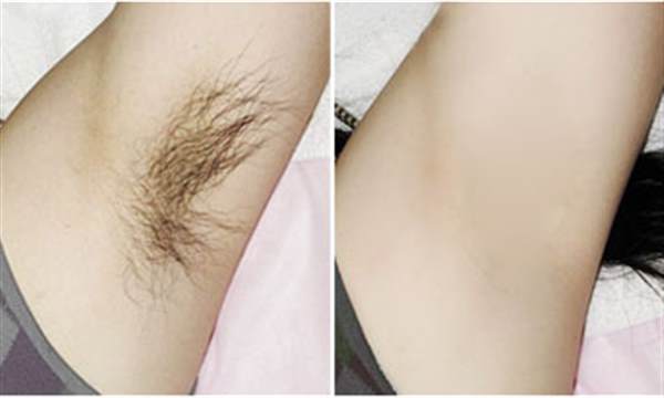 女人光子<a href=http://m.f3bb6.cn/listinfo-670-0.html target=_blank class=infotextkey>脫毛</a>術后注意事項