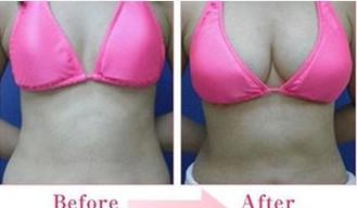 自體脂肪<a href=http://m.f3bb6.cn/listinfo-618-0.html target=_blank class=infotextkey>隆胸</a>的須知