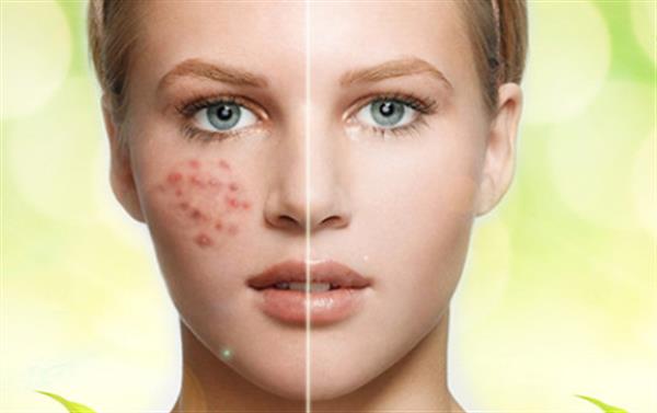 <a href=http://m.f3bb6.cn/listinfo-781-0.html target=_blank class=infotextkey>祛痘印</a>祛痘疤痘坑效果怎么樣