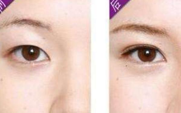 眼皮抽脂的手術多少錢