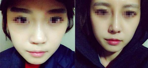 軟骨<a href=http://m.f3bb6.cn/listinfo-737-0.html target=_blank class=infotextkey>隆鼻</a>的缺點有哪些