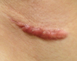 疤痕增生手術真的會疼嗎