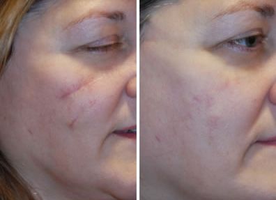 臉上有疤痕怎么辦怎么去除臉上的疤痕