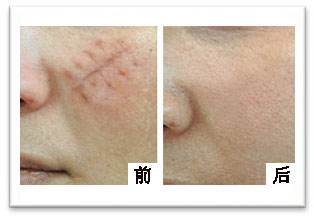面部疤痕修復(fù)多少錢