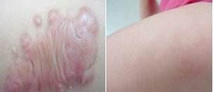 快速去除疤痕的3種方法