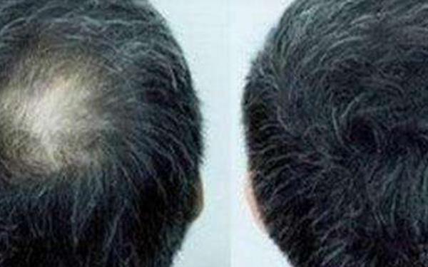 頭發種植是長期的嗎