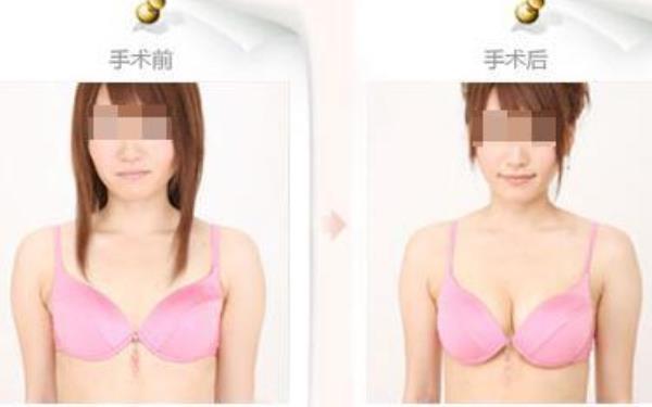 注射豐胸大概多少錢