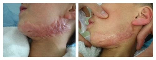 燒傷疤痕修復(fù)大概需要多少錢