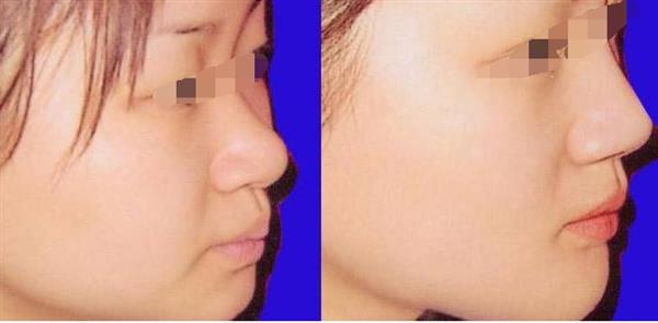 成都膨體<a href=http://m.f3bb6.cn/listinfo-737-0.html target=_blank class=infotextkey>隆鼻</a>能使用多久