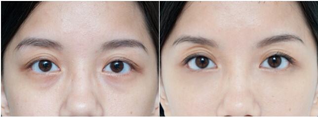 做掉眼袋需要多少錢