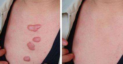 激光<a href=http://m.f3bb6.cn/listinfo-783-0.html target=_blank class=infotextkey>祛疤</a>大概需要多少錢