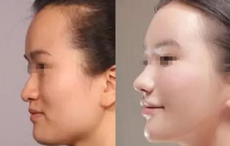 成都膨體<a href=http://m.f3bb6.cn/listinfo-737-0.html target=_blank class=infotextkey>隆鼻</a>手術后注意事項有哪些
