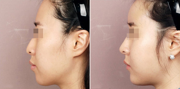 鼻子太大怎么整形