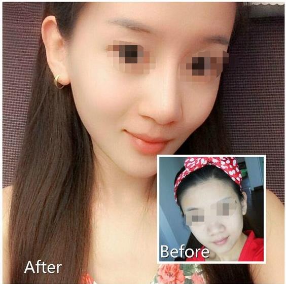 打<a href=http://m.f3bb6.cn/listinfo-631-0.html target=_blank class=infotextkey>瘦臉</a><a href=http://m.f3bb6.cn/listinfo-614-0.html target=_blank class=infotextkey>除皺</a>可以喝酒嗎