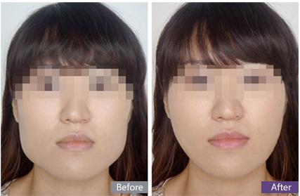 打完<a href=http://m.f3bb6.cn/listinfo-631-0.html target=_blank class=infotextkey>瘦臉</a><a href=http://m.f3bb6.cn/listinfo-614-0.html target=_blank class=infotextkey>除皺</a>多久能吃辣