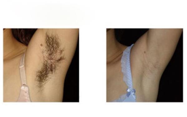 腋下<a href=http://m.f3bb6.cn/listinfo-670-0.html target=_blank class=infotextkey>脫毛</a>有危害嗎