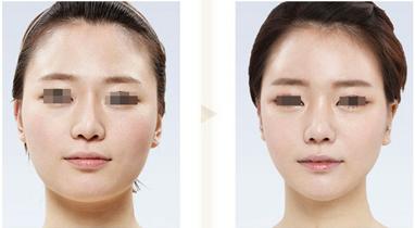 <a href=http://m.f3bb6.cn/listinfo-631-0.html target=_blank class=infotextkey>瘦臉</a><a href=http://m.f3bb6.cn/listinfo-614-0.html target=_blank class=infotextkey>除皺</a>打完多久見效