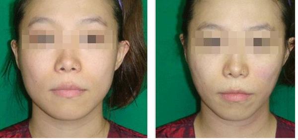 打完肉毒能可以<a href=http://m.f3bb6.cn/listinfo-687-0.html target=_blank class=infotextkey>減肥</a>藥嗎