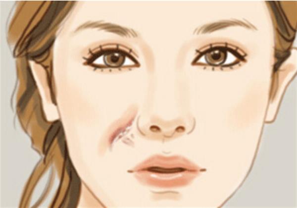 臉上疤痕能完全去掉嗎