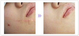 注射<a href=http://m.f3bb6.cn/listinfo-783-0.html target=_blank class=infotextkey>祛疤</a>可能會引起皮膚并發癥