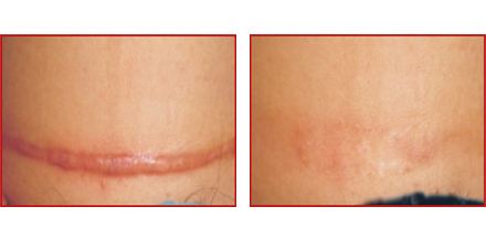 整形手術疤痕如何修復完善