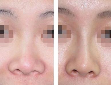 鼻子打透明質酸維持多久