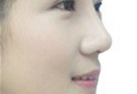 墊鼻梁多久能恢復(fù)