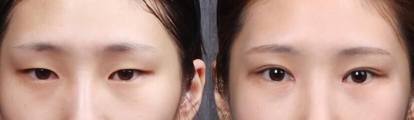 <a href=http://m.f3bb6.cn/listinfo-711-0.html target=_blank class=infotextkey>開眼角</a>的疤多久能恢復