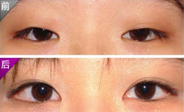 <a href=http://m.f3bb6.cn/listinfo-724-0.html target=_blank class=infotextkey>雙眼皮</a>手術(shù)前后對(duì)照