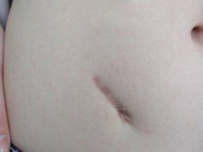 生活中常見的疤痕類型