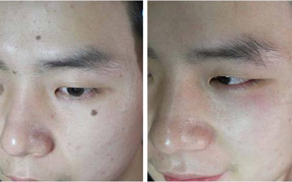 激光點痣大概要多少錢