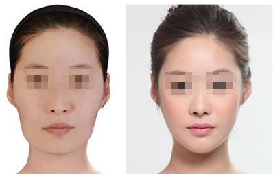 長春注射保妥適<a href=http://m.f3bb6.cn/listinfo-614-0.html target=_blank class=infotextkey>除皺</a>瘦型素<a href=http://m.f3bb6.cn/listinfo-631-0.html target=_blank class=infotextkey>瘦臉</a>需要多少錢