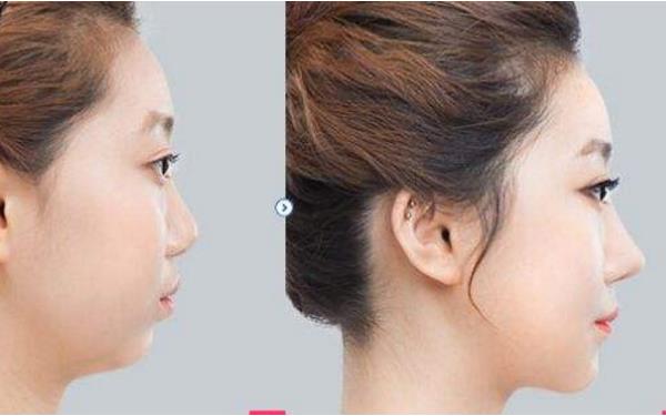 福州<a href=http://m.f3bb6.cn/listinfo-737-0.html target=_blank class=infotextkey>隆鼻</a>價格