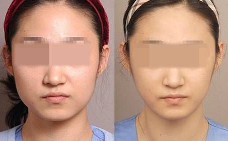 打一次<a href=http://m.f3bb6.cn/listinfo-631-0.html target=_blank class=infotextkey>瘦臉</a><a href=http://m.f3bb6.cn/listinfo-614-0.html target=_blank class=infotextkey>除皺</a>要多少錢