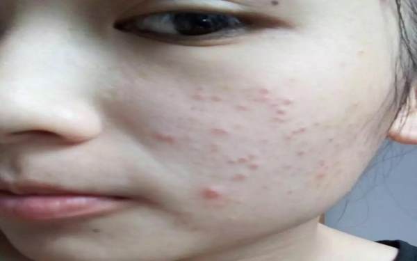 光子<a href=http://m.f3bb6.cn/listinfo-770-0.html target=_blank class=infotextkey>嫩膚</a>去痘印多少錢