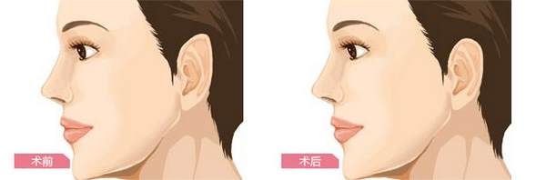 招風(fēng)耳糾正多少錢