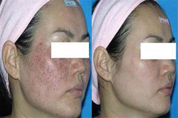 臉部擦傷色素能消退嗎