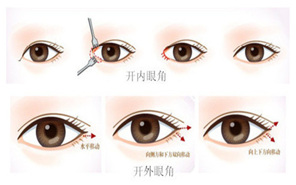 男生開內(nèi)眼角前后對比