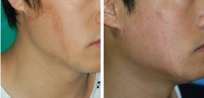 如何修復臉上的疤痕