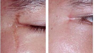 臉上的凹陷疤能恢復嗎